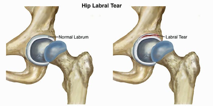 hip-arthroscopy-labral-tear-diagram